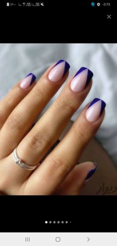 کاشت ژل با فرنج موقت