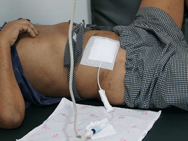 دیالیز در منزل در تجریش