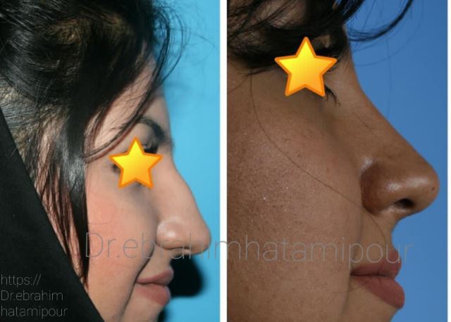 بهترین جراح بینی در شیراز