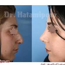 بهترین جراح بینی در شیراز
