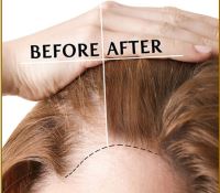 بهترین مزوتراپی در تهران کجاست؟