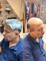 پروتز مو طبیعی بدون چسب