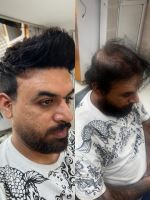 پروتز مو طبیعی بدون چسب