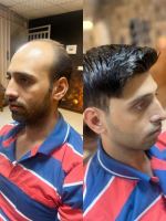 پروتز مو طبیعی بدون چسب