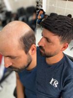 پروتز مو طبیعی بدون چسب