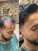 پروتز مو طبیعی بدون چسب