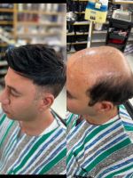 پروتز مو طبیعی بدون چسب