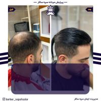 پروتز مو طبیعی بدون چسب