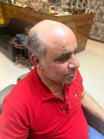 پروتز مو طبیعی بدون چسب