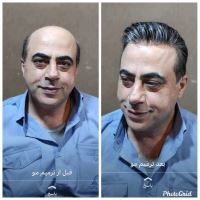 پروتز مو طبیعی بدون چسب