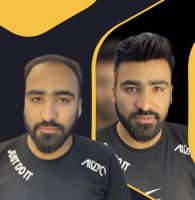 پروتز مو آرش دهقان