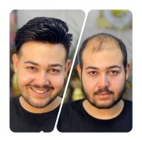 پروتز مو آرش دهقان