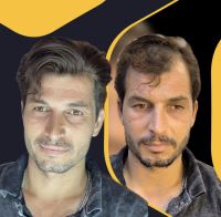 پروتز مو در شهرکرد