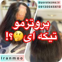 پروتز مو در شهرکرد