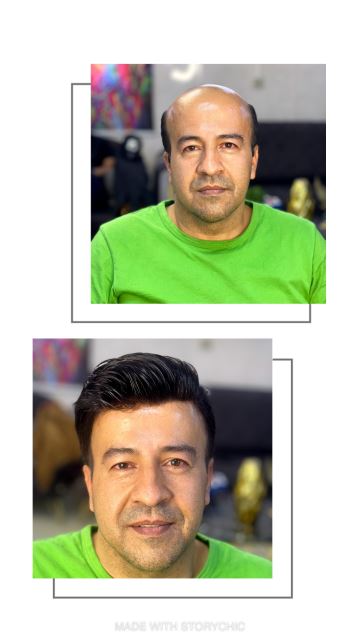 آموزش و متخصص پروتز مو در شهرضا 