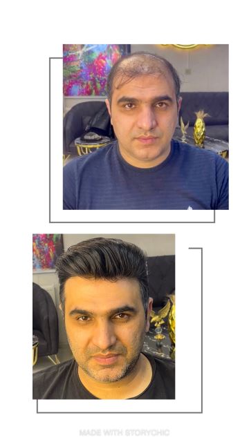 آموزش و متخصص پروتز مو در شهرضا 