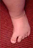 کفی طبی پای صاف