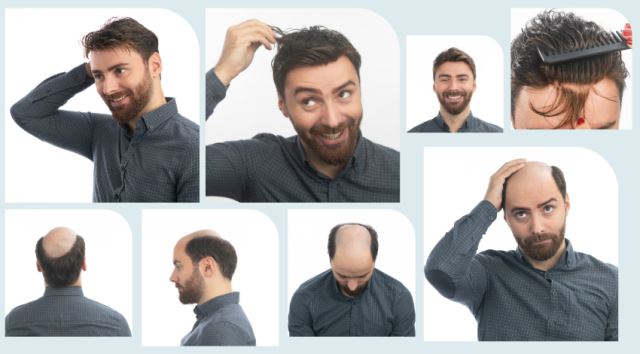 پروتز مو در لردگان