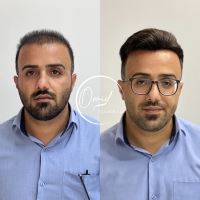 پروتز مو فلاورجان