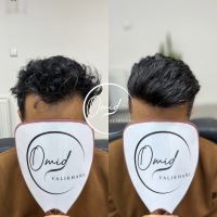 پروتز مو در خمینی شهر امید ولی خانی