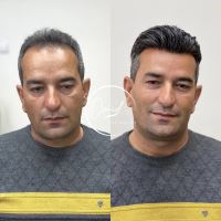 پروتز مو در خمینی شهر امید ولی خانی