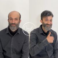 پروتز مو بهارستان