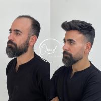 ترمیم مو در شاهین شهر