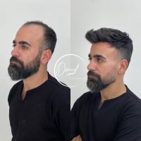 پروتز مو شهرضا