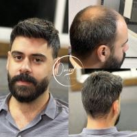 پروتز مو در شهرضا