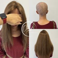 پروتز مو شهرضا