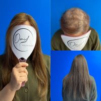 پروتز مو در شهرضا