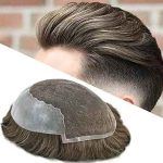 هزینه پروتز مو