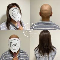 پروتز مو در نجف آباد