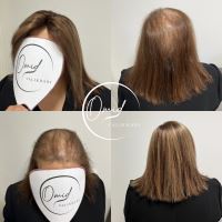 پروتز مو نجف اباد