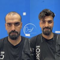 ترمیم و پروتز مو نجف آباد