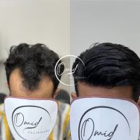 پروتز مو نجف آباد