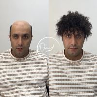 بهترین پروتز مو نجف آباد