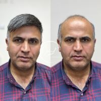 پروتز مو زرین شهر