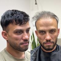 پروتز مو زرین شهر