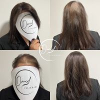 پروتز مو در زرین شهر