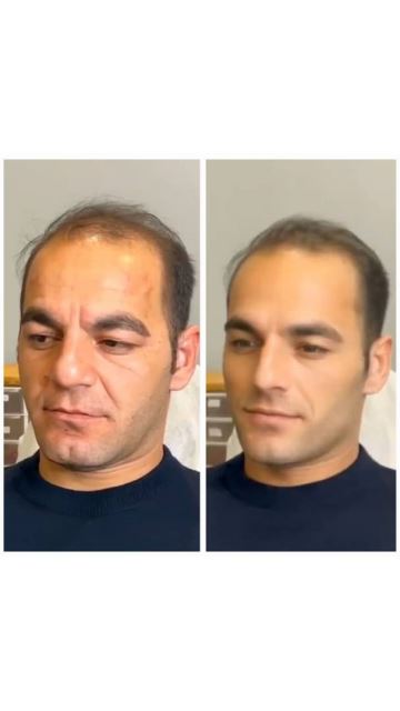 تزریق پروفایلو