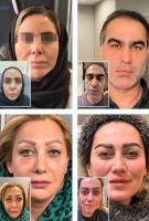 تزریق پروفایلو