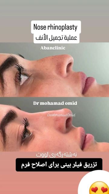 تزریق پروفایلو