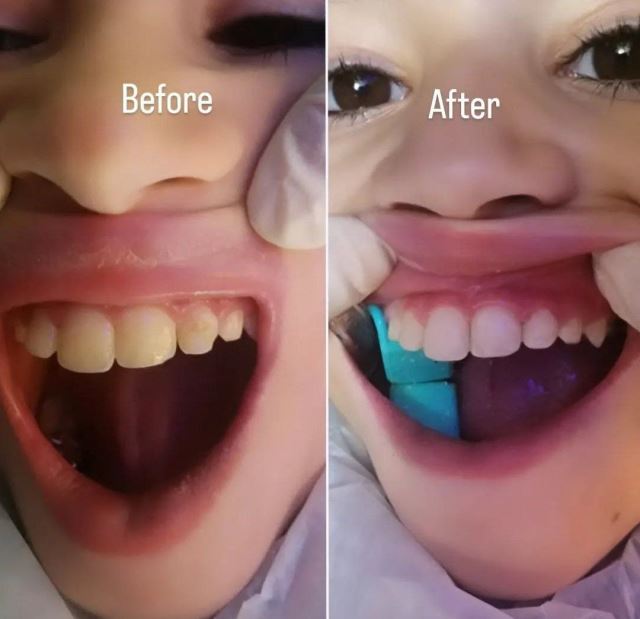 پلاکهای فضانگهدار دو طرفه فک پایین