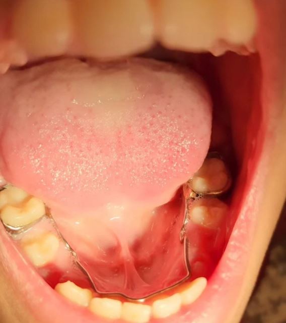 پلاکهای فضانگهدار دو طرفه فک پایین