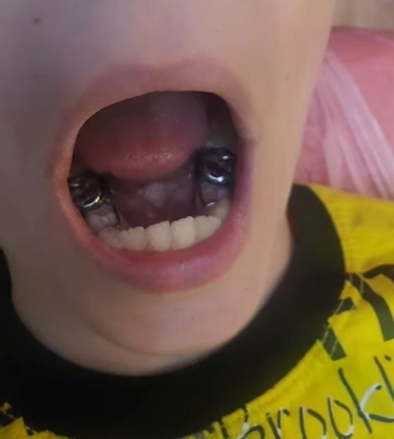 پلاکهای فضانگهدار دو طرفه فک پایین