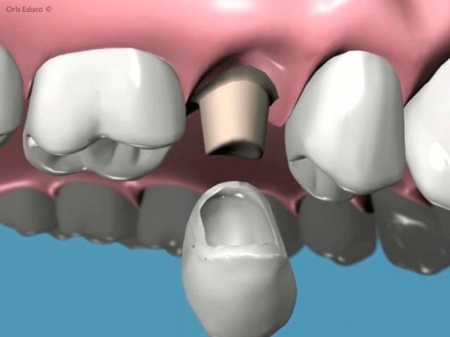 کامپوزیت اقساطی در تهران 