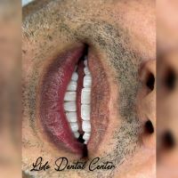 بهترین مرکز ایمپلنت تهران