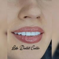 لمینت اقساطی تهران