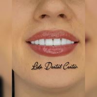 لمینت اقساطی تهران